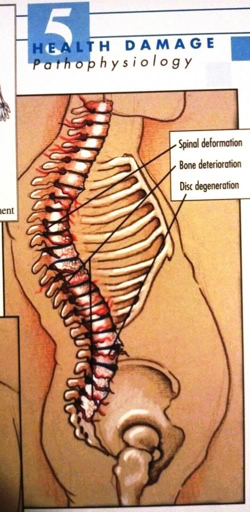 vertebral subluxation